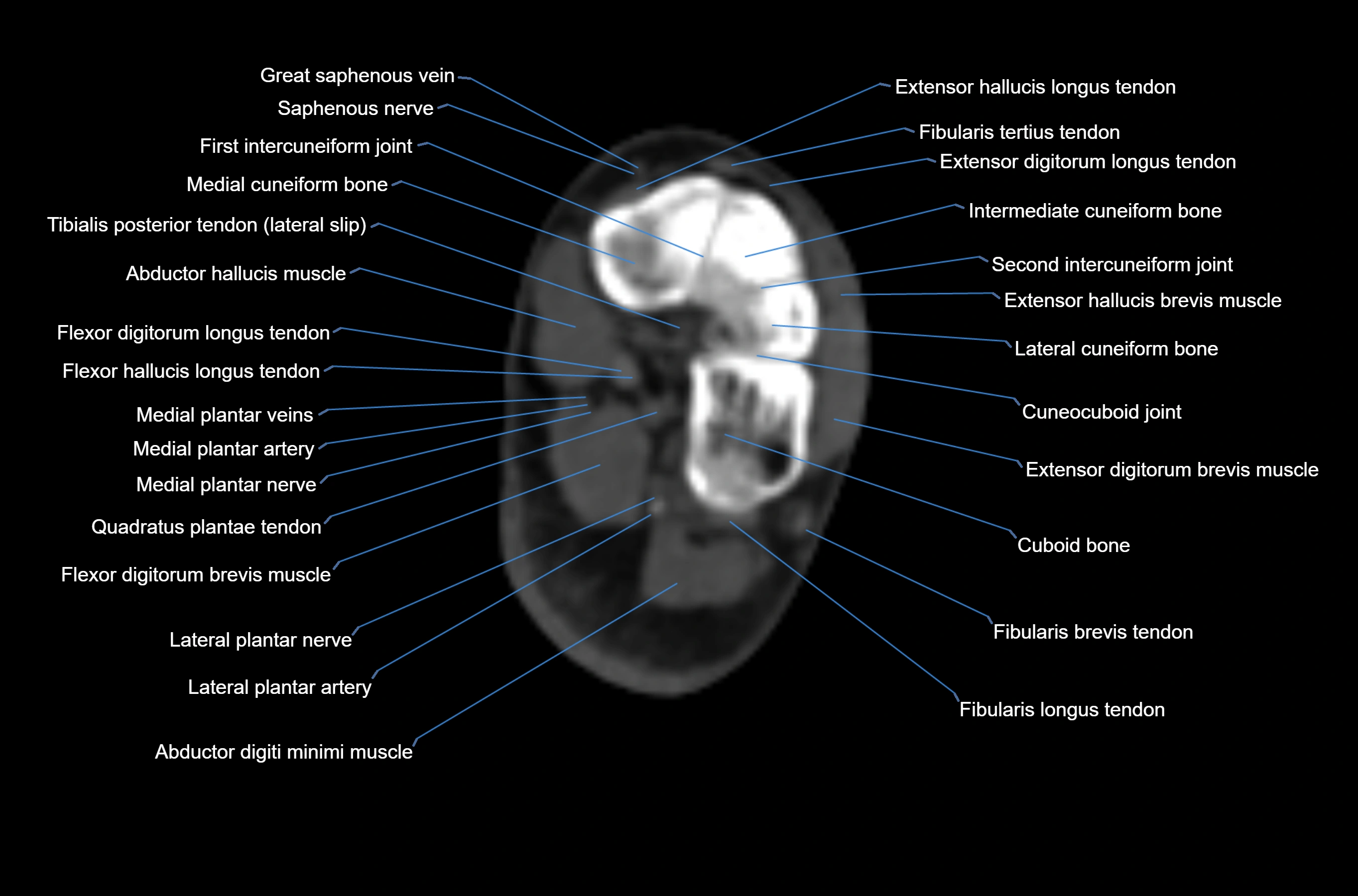 CT Ankle axial cross sectional anatomy labelled image -00050.webp